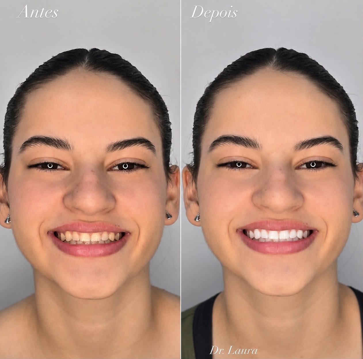Clareamento dental